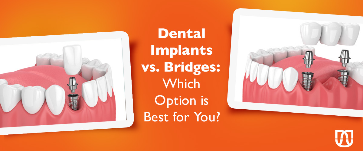 Dental Implants vs. Bridges: Which Option is Best for You? - Moraga ...