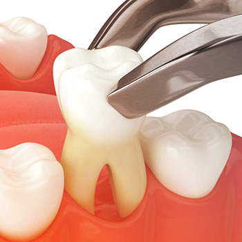 Extractions