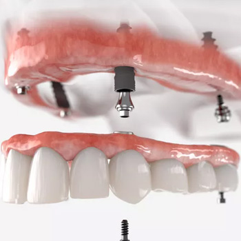 Prosthodontics